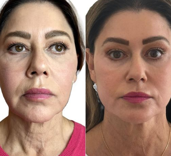 filler before after